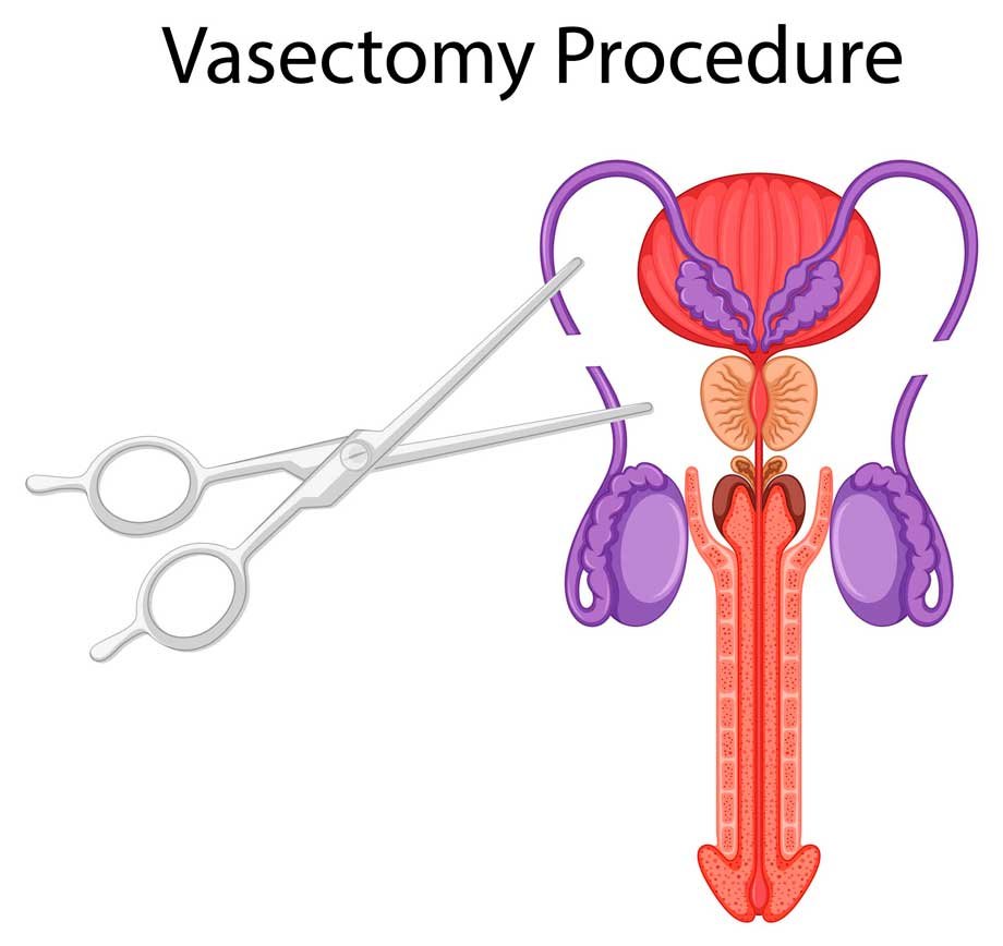 Dibujo sobre cómo es el procedimiento de la vasectomía.